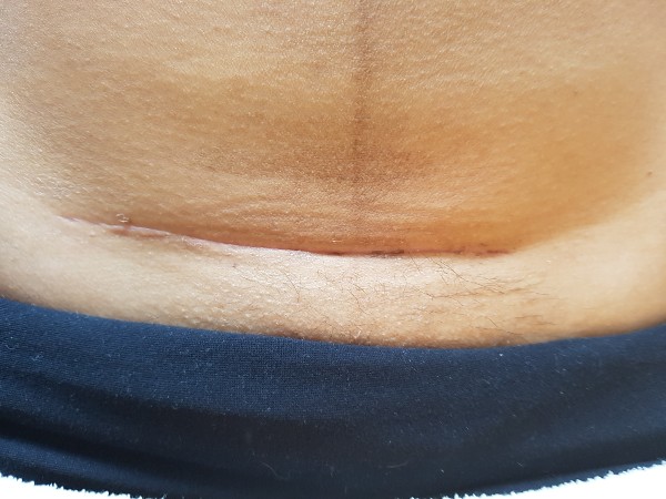 Resultat efter en MSTR®behandling